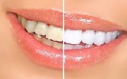 Dentální hygiena BRNO - Bělení zubů