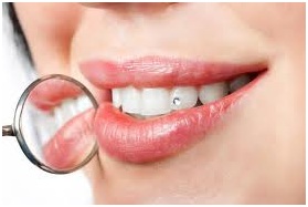 Dentální hygiena BRNO - Zubní šperky